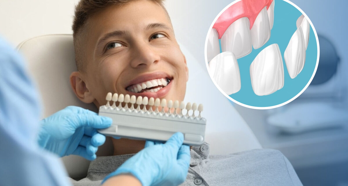 What Are Composite Veneers