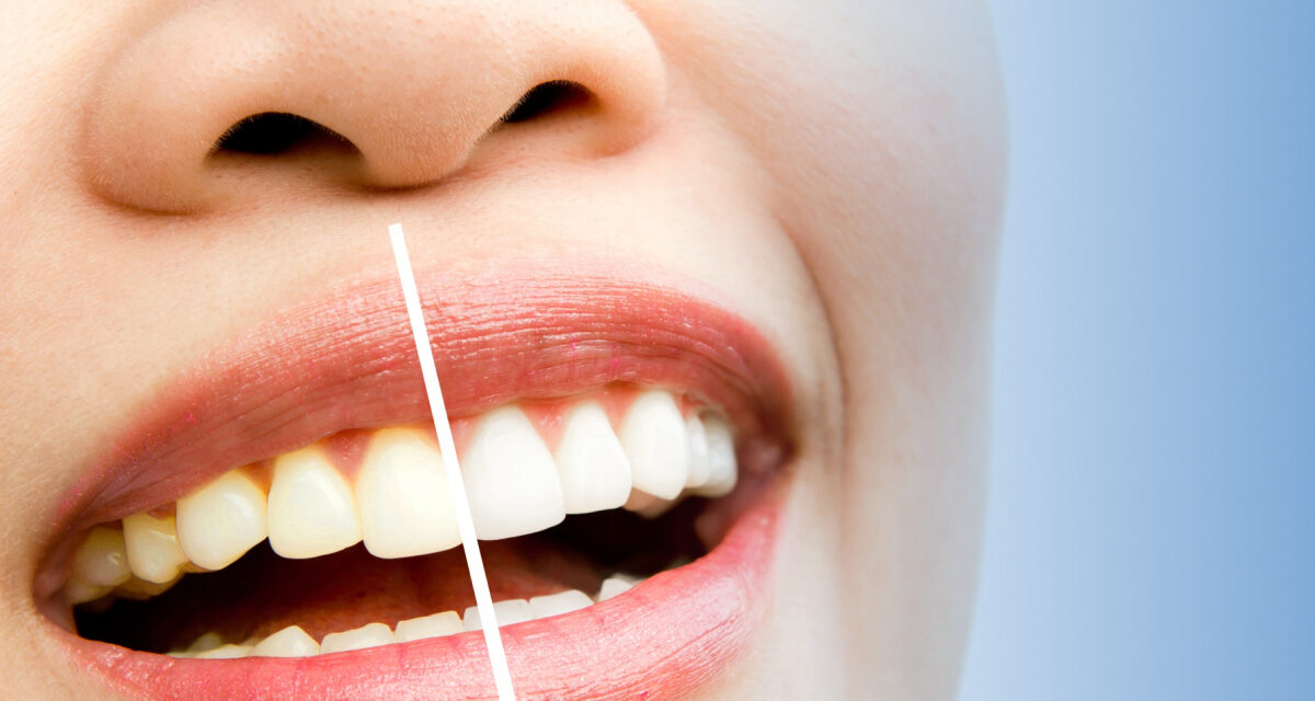 How Long Does Teeth Whitening Last