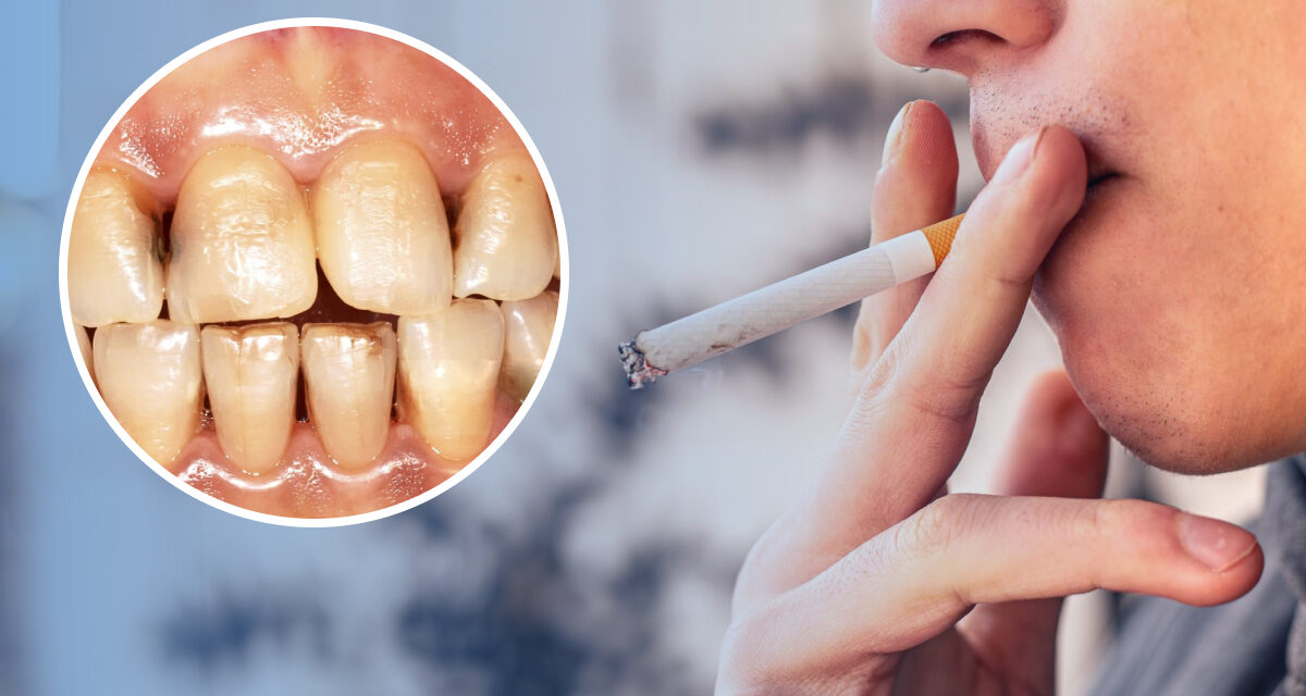 Effects of Smoking on Teeth