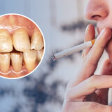 Effects of Smoking on Teeth