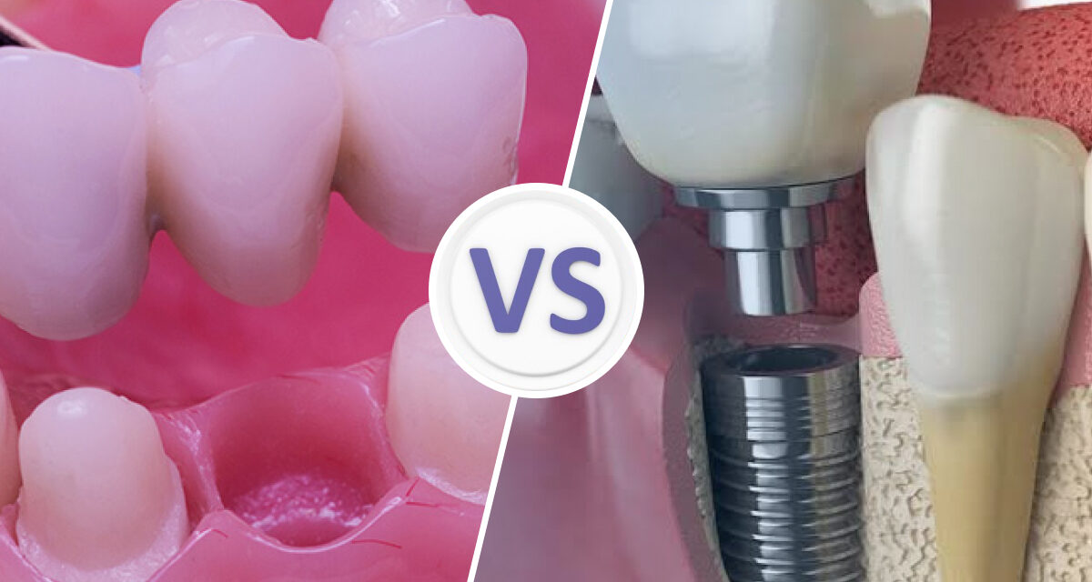 Tooth Implant vs Dental Bridge?