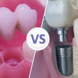 tooth implant vs dental bridge