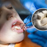 How Does Sugar Cause Cavities?